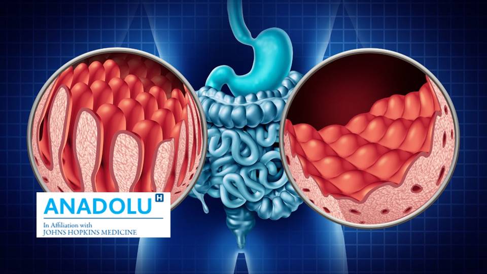 Comprendre la maladie cœliaque: causes, symptômes et traitement